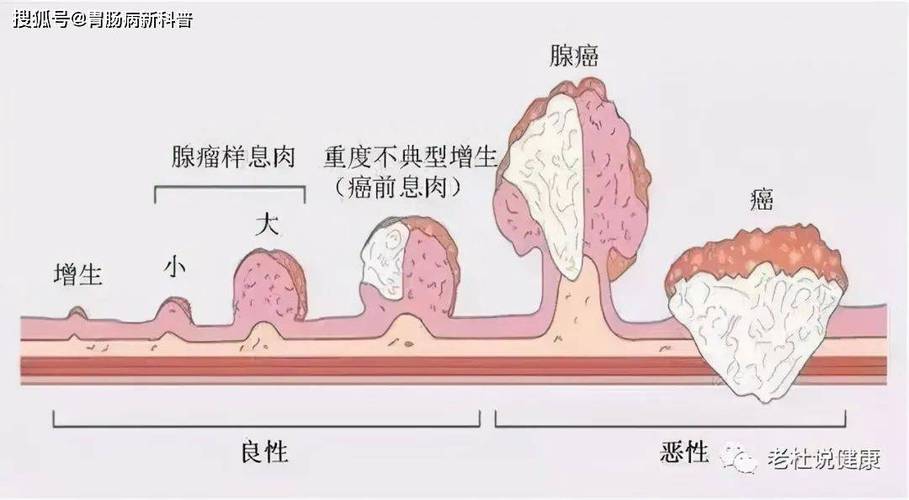 息肉和癌可能是“近亲” 做胃肠镜检查更应赶在无症状之前