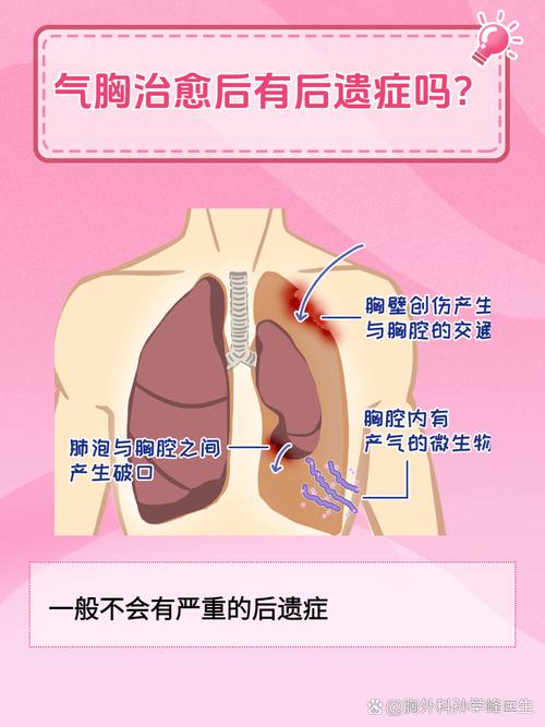 气胸最常见症状是胸闷和憋气