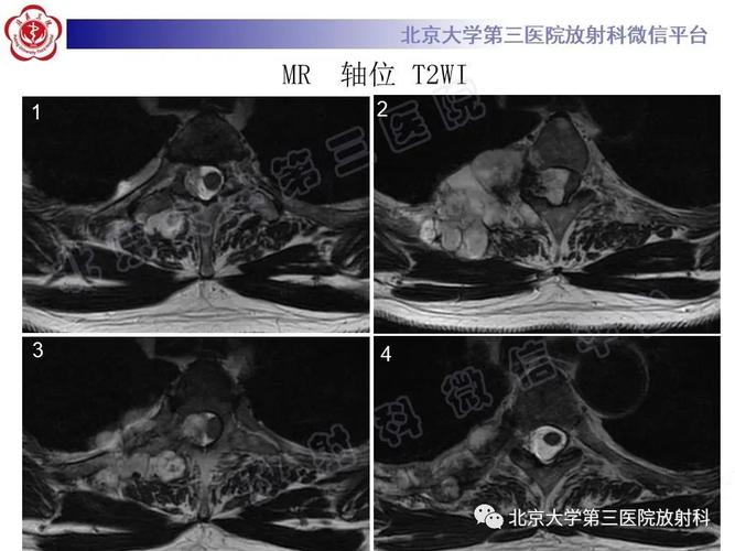 男子脊柱旁长出鸭蛋大小软骨肉瘤，多学科携手精细排雷